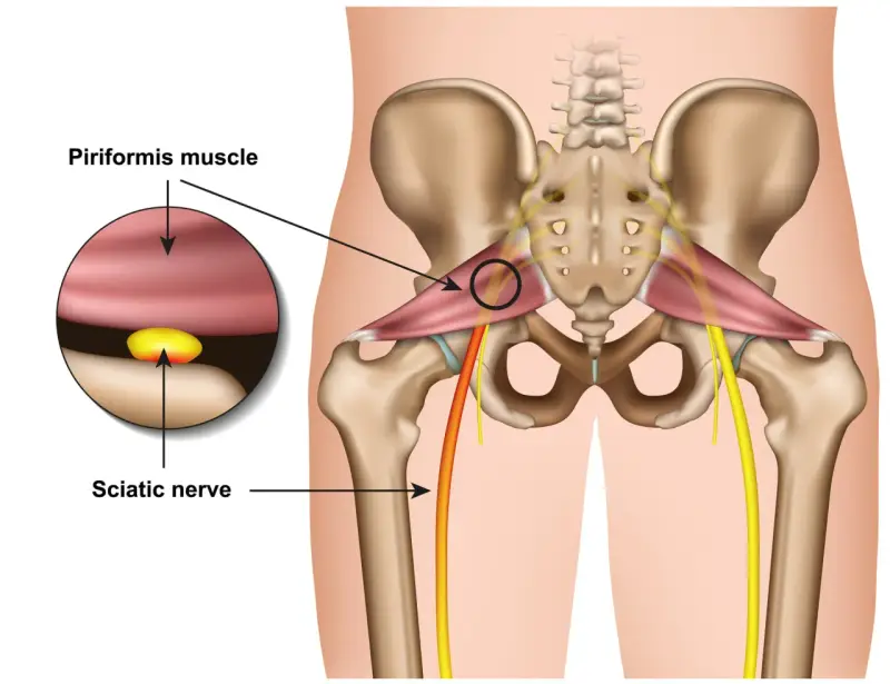 Illustration zeigt das Piriformis-Syndrom: Der Piriformis-Muskel drückt auf den Ischiasnerv.