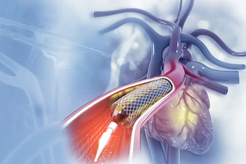 Stent w tętnicy serca podczas zabiegu angioplastyki.