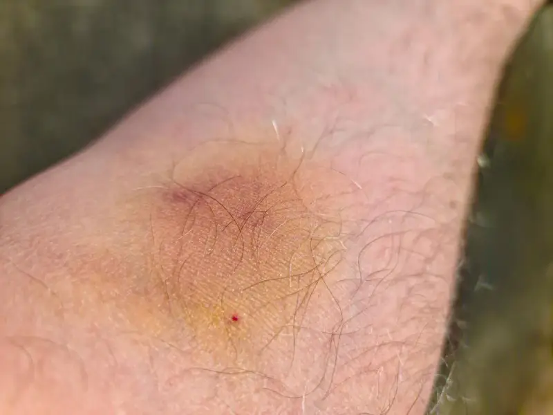 Ein blauer Fleck auf der Haut, der leicht juckt. Die Haut ist leicht gerötet und von feinen Härchen bedeckt.