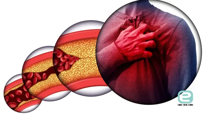 Postępująca choroba wieńcowa: zwężone naczynia krwionośne z cholesterolem i czerwonymi krwinkami, obok mężczyzna trzymający się za serce.