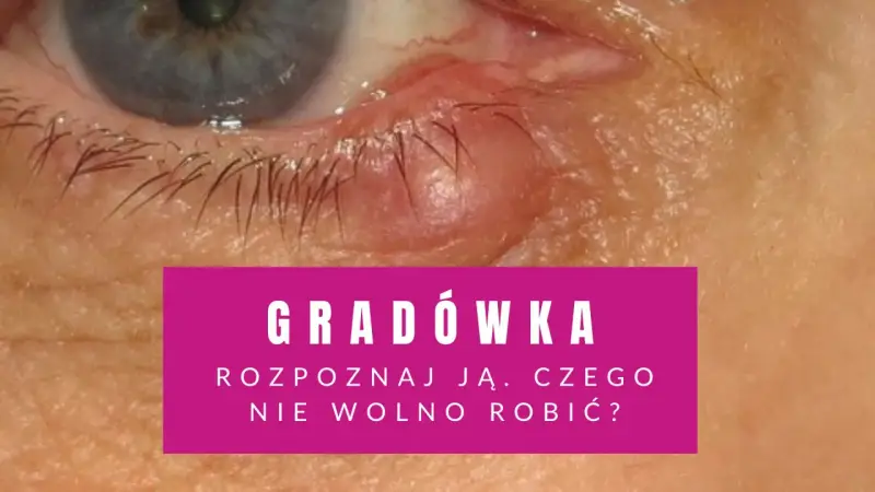 Widoczna gradówka wewnątrz powieki, czerwona i opuchnięta. Tekst informuje o rozpoznawaniu i postępowaniu.