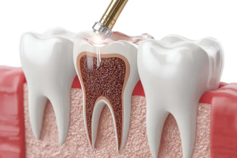 Zabieg stomatologiczny: narzędzie dentystyczne usuwa tkankę z zęba, lecząc zatrucie zęba.