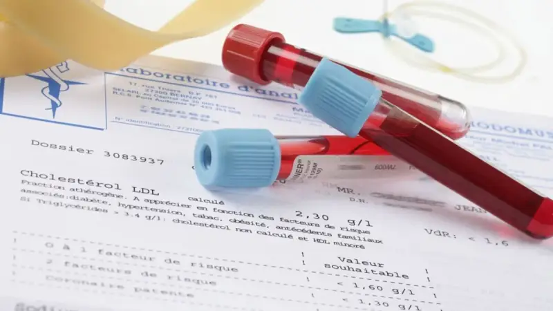 Próbki krwi w probówkach leżą na wynikach badań, gdzie widnieje m.in. poziom cholesterolu LDL. Wyniki mogą wskazywać na potrzebę monitorowania białka c reaktywnego.