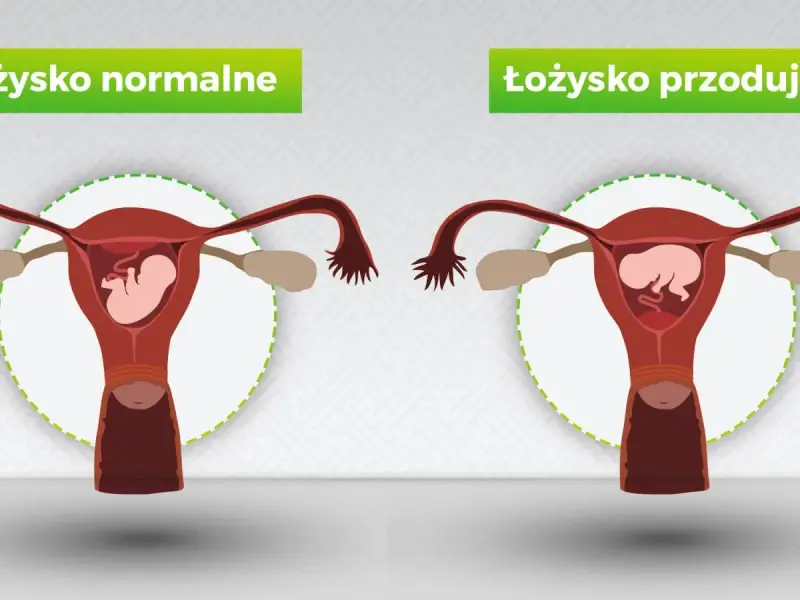 Porównanie: łożysko normalne vs łożysko przodujące. Na obrazku widać macicę z płodem. Po prawej łożysko przodujące, które może blokować szyjkę macicy.