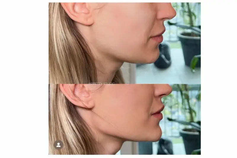 Endermologia twarzy: Lifting bez skalpela? Sprawdź efekty!