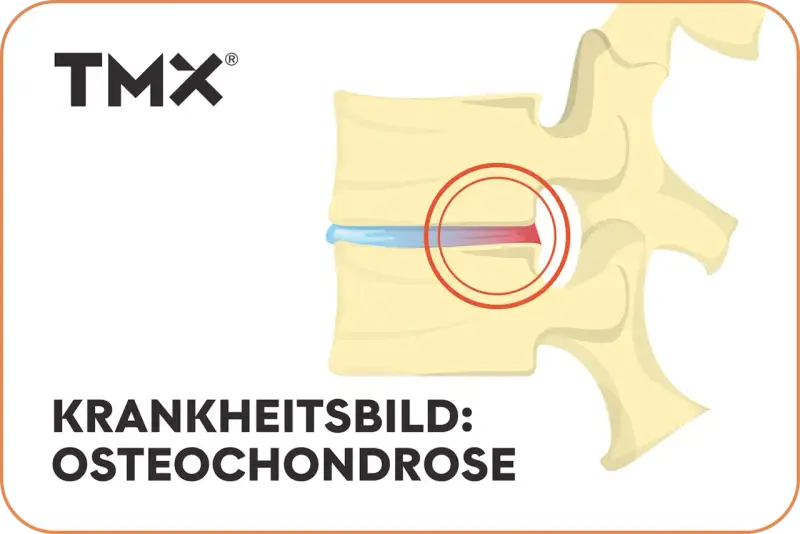 Darstellung eines Wirbels mit Bandscheibenschaden. Bei Osteochondrose wie geht es weiter? TMX Logo.
