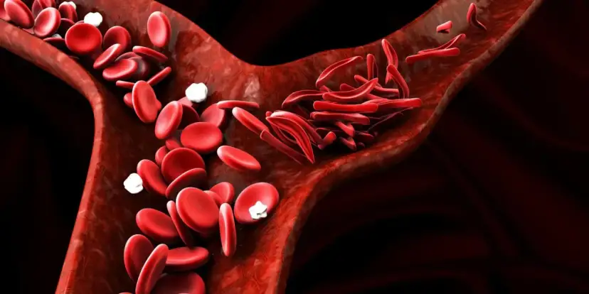 Naczynia krwionośne z prawidłowym i sierpowatym kształtem erytrocytów. Czy anemia może być ze stresu?