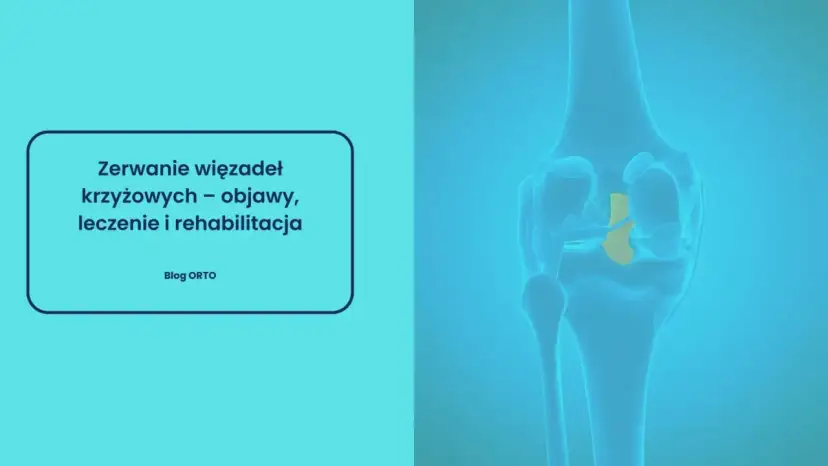 Ilustracja przedstawia zerwane więzadło krzyżowe w kolanie. Czy zerwane więzadło boli? Dowiedz się o objawach, leczeniu i rehabilitacji.