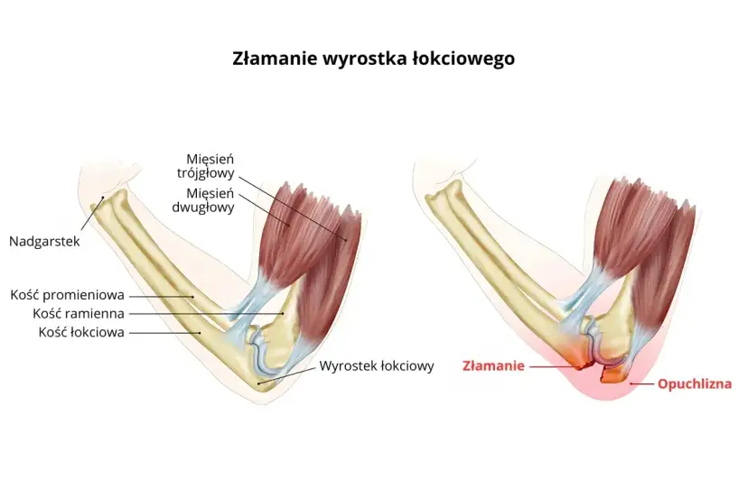 Ilustracja pokazuje złamanie wyrostka łokciowego po upadku. Widoczne jest zniekształcenie i opuchlizna w okolicy łokcia.