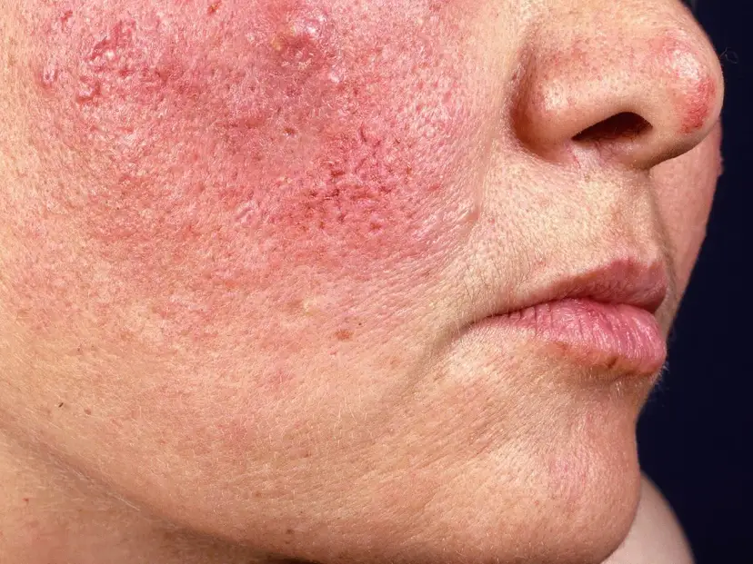 Haut brennt nach Creme? Ursachen & Soforthilfe vom Profi