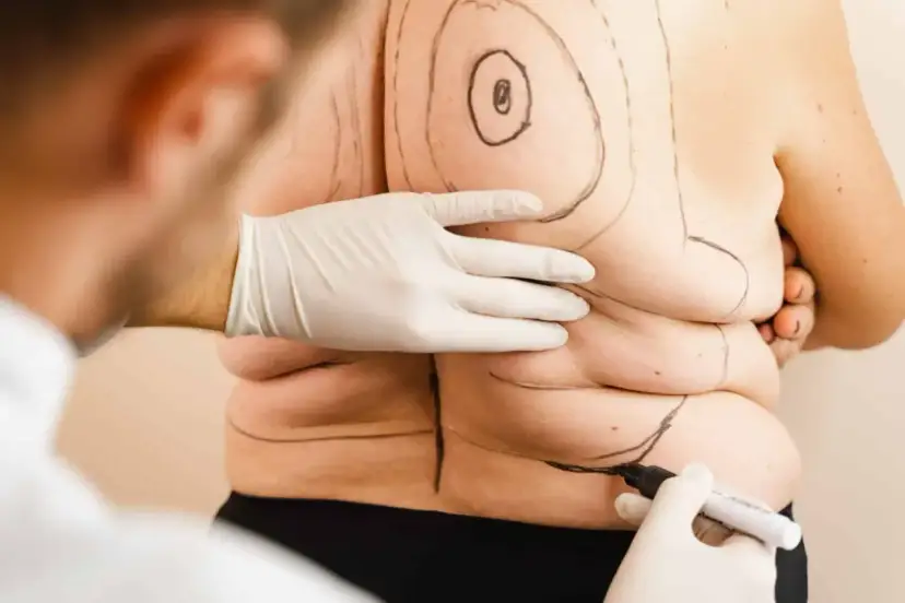 Liposukcja: Co to jest? Zrozum zabieg modelowania sylwetki