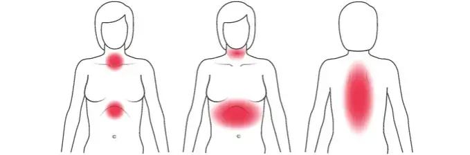 Herzinfarkt Frauen Symptome: Unterschätzte Anzeichen rechtzeitig erkennen