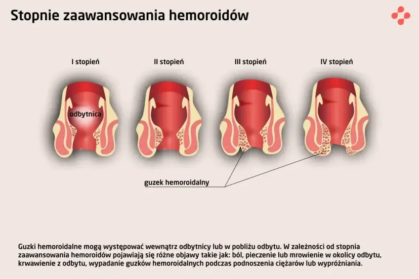 Hemoroidy: Do jakiego lekarza? Proktolog wyjaśnia, co musisz wiedzieć