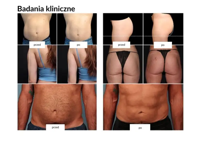 Badania kliniczne pokazują spektakularne trening ems efekty przed i po: widoczna redukcja tkanki tłuszczowej na brzuchu i pośladkach.