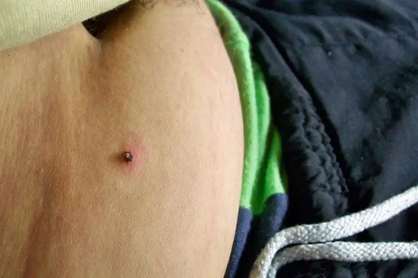 Kleszcz pod skórą: Czy to groźne? Objawy, KZM, rumień poradnik