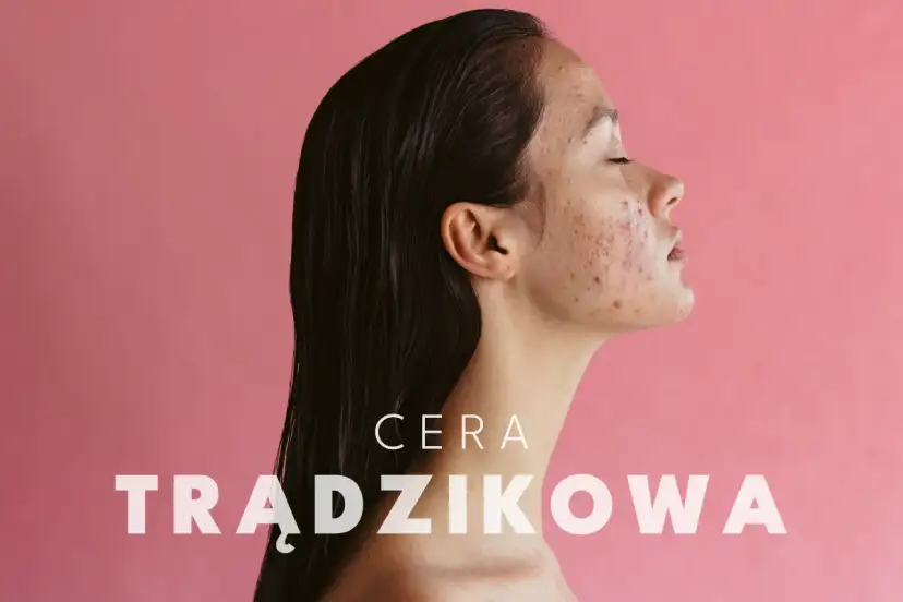 Profil kobiety z cerą trądzikową. Dowiedz się, jak dbać o cerę trądzikową i odzyskać jej zdrowy wygląd.