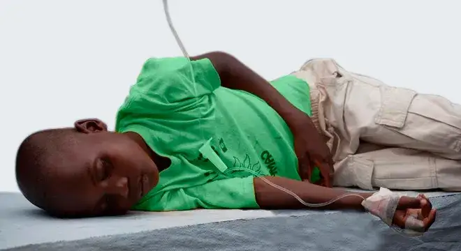 Cholera Symptome: Warnzeichen erkennen und ernsthafte Folgen vermeiden