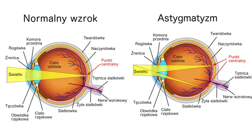 Schemat oka z normalnym wzrokiem i astygmatyzmem, pokazujący drogę światła.
