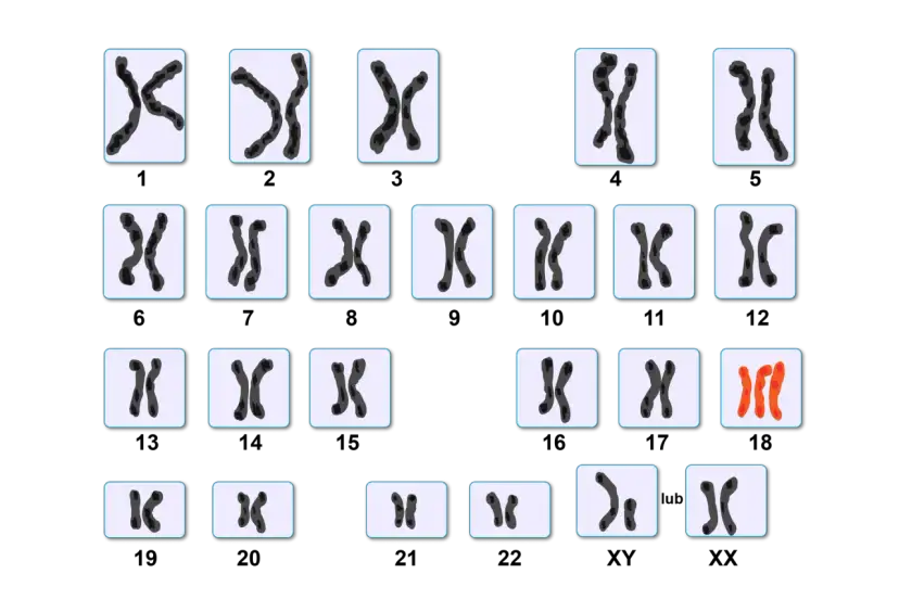 Kariotyp przedstawia pary chromosomów, w tym jedną parę w kolorze pomarańczowym, sugerującą anomalię.