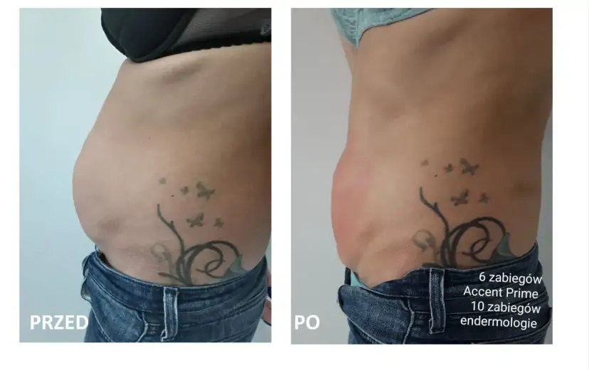 Przed i po zabiegu Accent Prime. Widoczna redukcja tkanki tłuszczowej brzucha, co pokazuje skuteczność liposukcji kawitacyjnej.