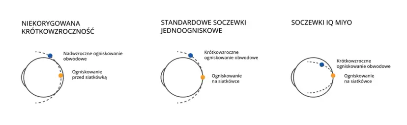 Schemat oka z ogniskowaniem światła przy krótkowzroczności i korekcji soczewkami.