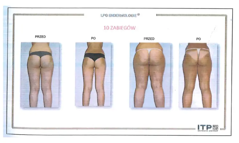 Endermologia: Jak często, ile zabiegów? Ekspert radzi!