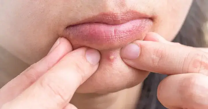 Jak pozbyć się podskórnego pryszcza? Szybkie i bezpieczne domowe sposoby