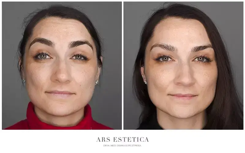 Ile jednostek botoksu na czoło? Dawka, koszt i efekty