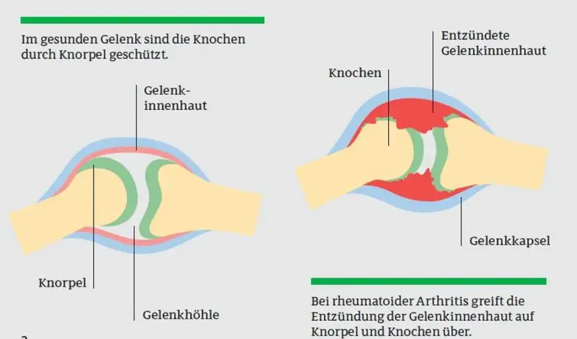 Die häufigsten Symptome der rheumatoiden Arthritis und ihre Folgen