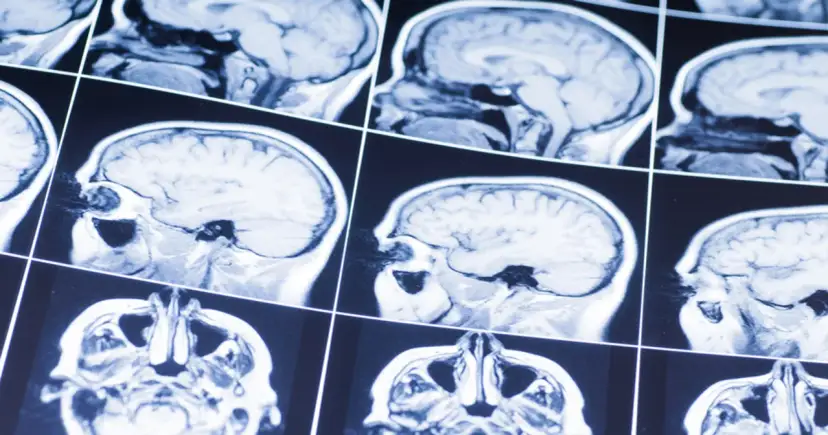 Przyczyny udaru mózgu: Poznaj czynniki ryzyka i jak im zapobiegać