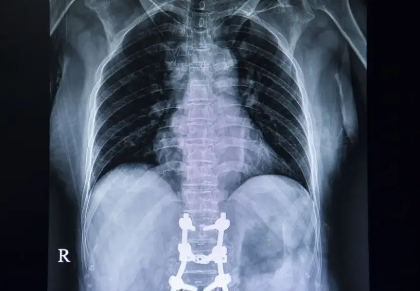 Operacja kręgosłupa lędźwiowego: Ile trwa rehabilitacja i co Cię czeka?