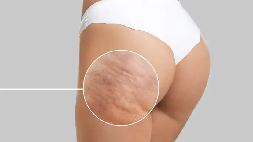 Cellulit na udach: Odkryj skuteczne metody na gładką skórę!