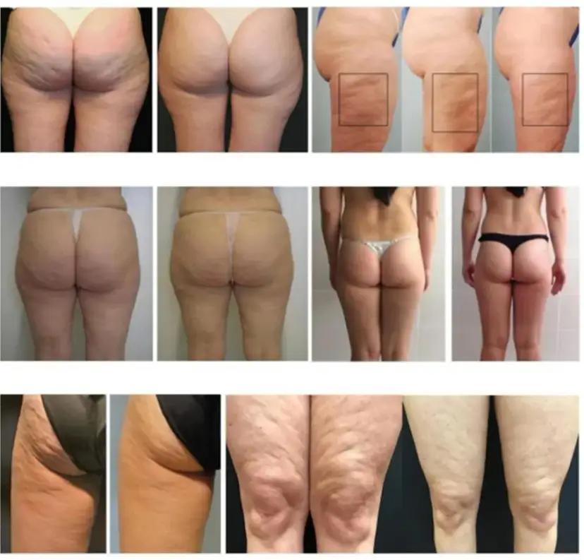 Jaki zabieg na cellulit? Skuteczne metody i porównanie