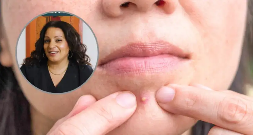 Jak długo trzymać pastę do zębów na pryszcze, aby uniknąć podrażnień?