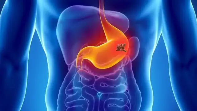 Magenkrebs Symptome bei Frauen: Warnzeichen, die Sie nicht ignorieren sollten