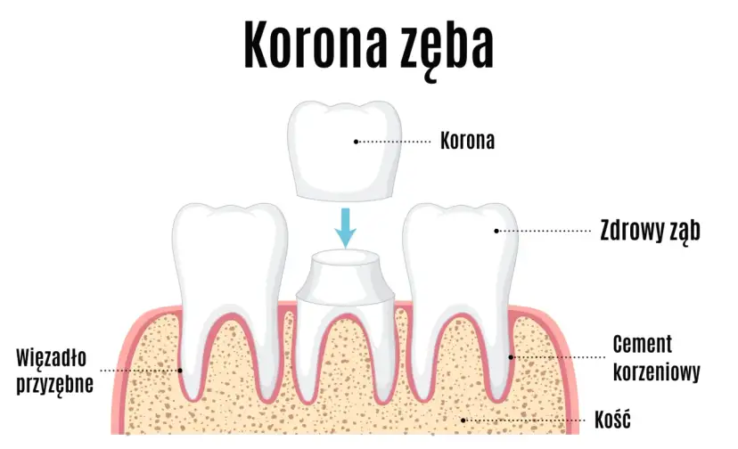 Wyrwanie zęba: Ile kosztuje i jak uniknąć ukrytych opłat?