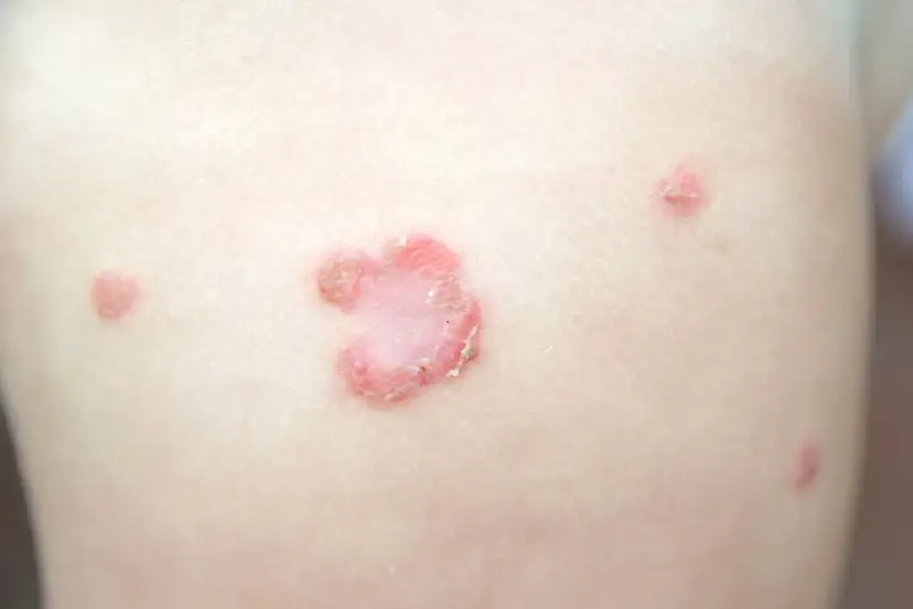 Liszaj u dziecka czym smarować - skuteczne metody leczenia i porady