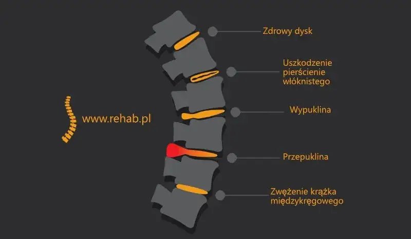 Skręcenie kręgosłupa lędźwiowego: objawy, przyczyny i co robić?