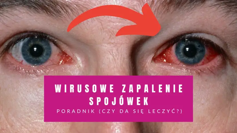 Czerwone, podrażnione oczy z czerwoną strzałką wskazującą na zapalenie. Poradnik: wirusowe zapalenie spojówek - jaki lek na zapalenie spojówek?