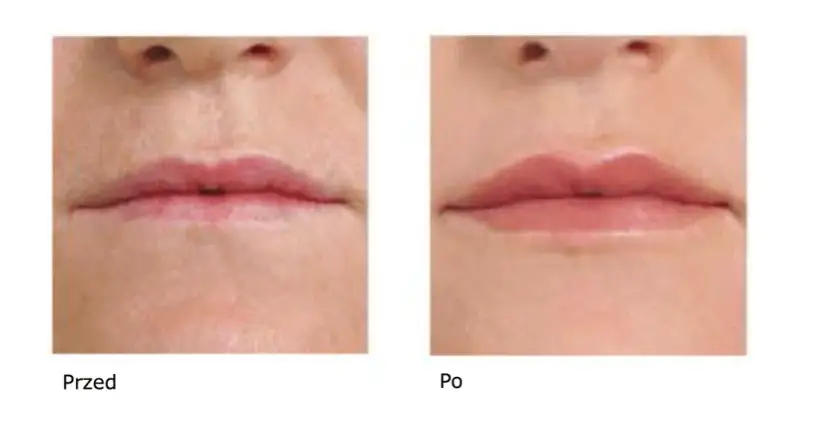 Ile utrzymuje się kwas hialuronowy na twarzy? Zaskakujące fakty o trwałości