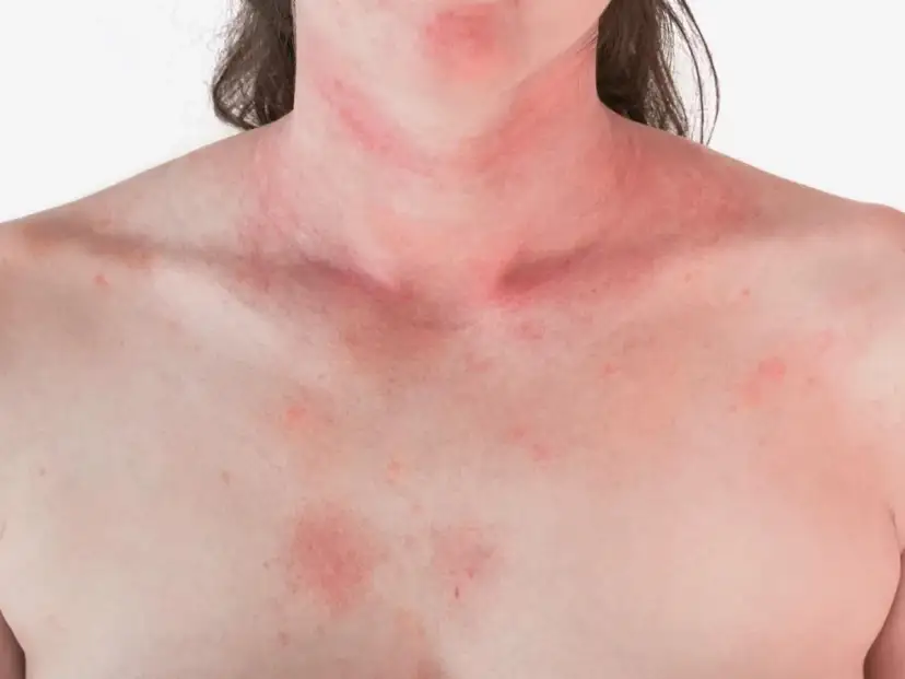 Czy truskawki uczulają? Alergia, nietolerancja objawy i leczenie