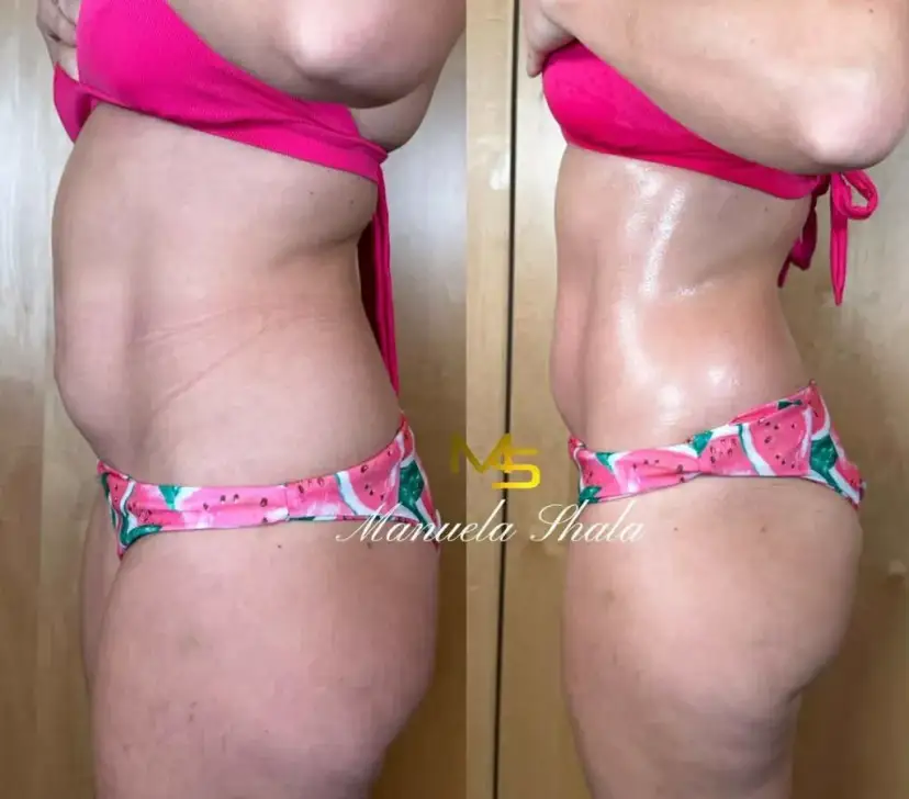 Drenaż limfatyczny: ile zabiegów potrzeba na trwałe efekty?