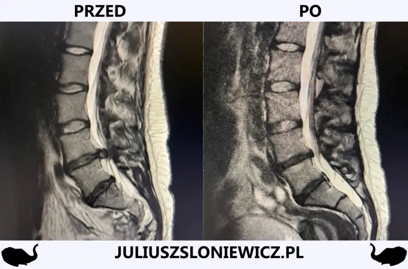 Rwa kulszowa: Zrozum objawy, znajdź ulgę i pokonaj ból!