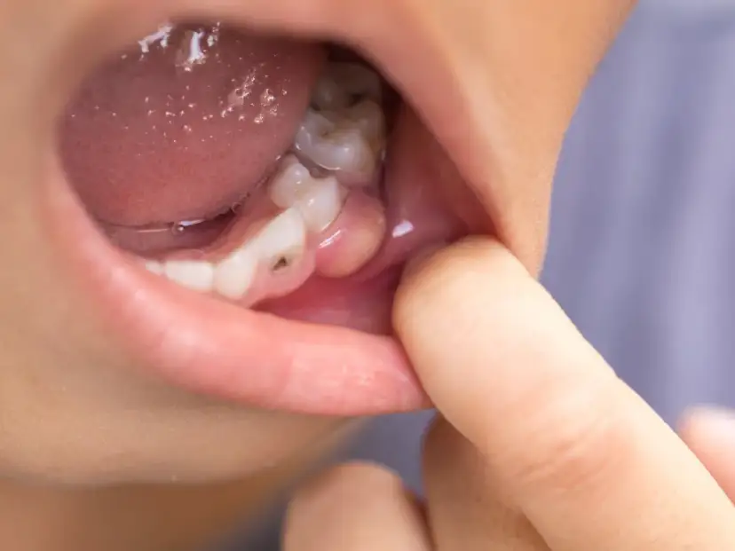 Widoczny ropień zęba przebicie na dziąśle, obok próchnicy.