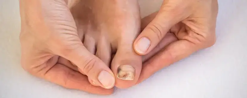 Czy czerniak paznokcia boli? Dowiedz się, co warto wiedzieć o objawach