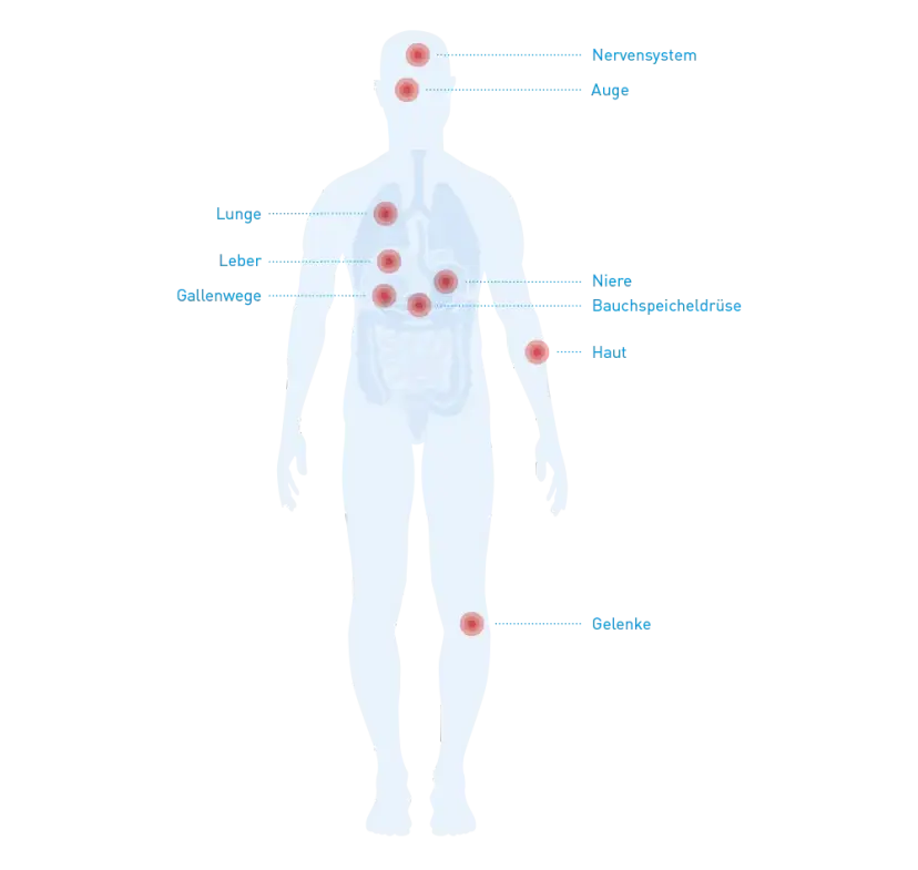 Morbus Crohn: Diese Medikamente unbedingt meiden (Ärzte-Tipps)