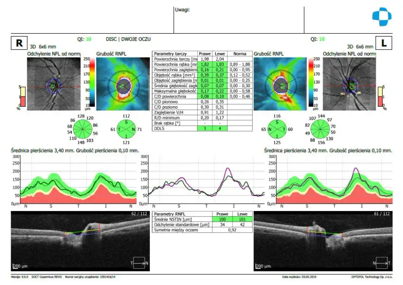 Badanie OCT: Co to jest, jak przebiega i czy wykryje jaskrę?