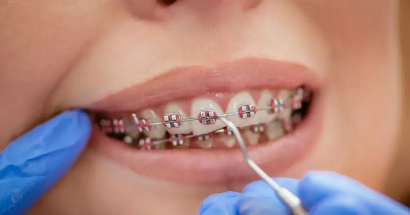 Ile trwa aparat na zęby? Ortodonta wyjaśnia, co wpływa na czas