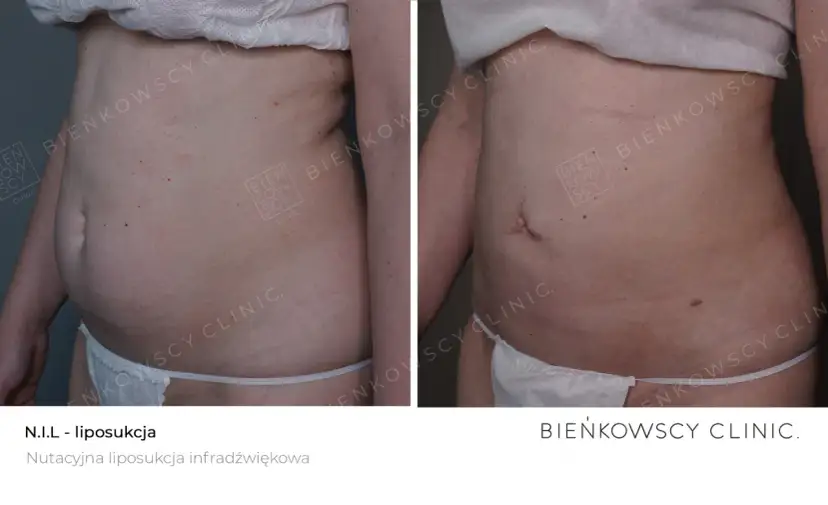 Liposukcja: Czy to dla Ciebie? Rodzaje, efekty, koszty - poradnik