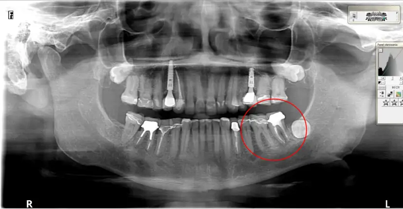 Pionowe pęknięcie korzenia zęba objawy – jak je rozpoznać i leczyć
